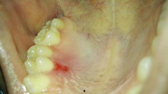 吃瓜上牙膛疼,揭秘口腔健康与饮食习惯的微妙关系